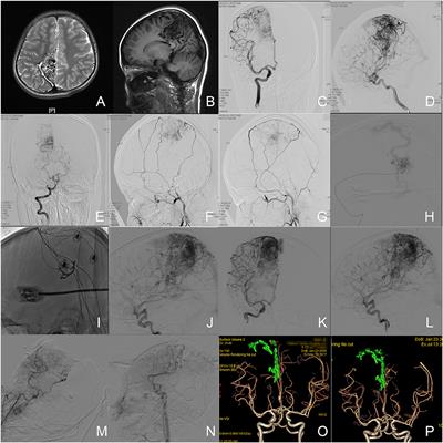 Comparison of Endovascular Embolization Plus Simultaneous Microsurgical Resection vs. Primary Microsurgical Resection for High-Grade Brain Arteriovenous Malformations